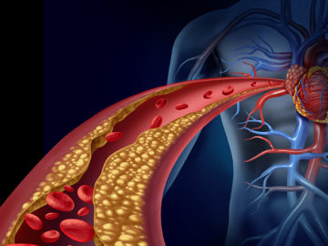 corinary-artery-disease